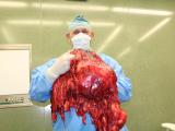 Profesor MUDr. Jiří Klein, PhD., FETCS, s vyoperovaným více než 27kilovým nádorem (Foto: KNTB)